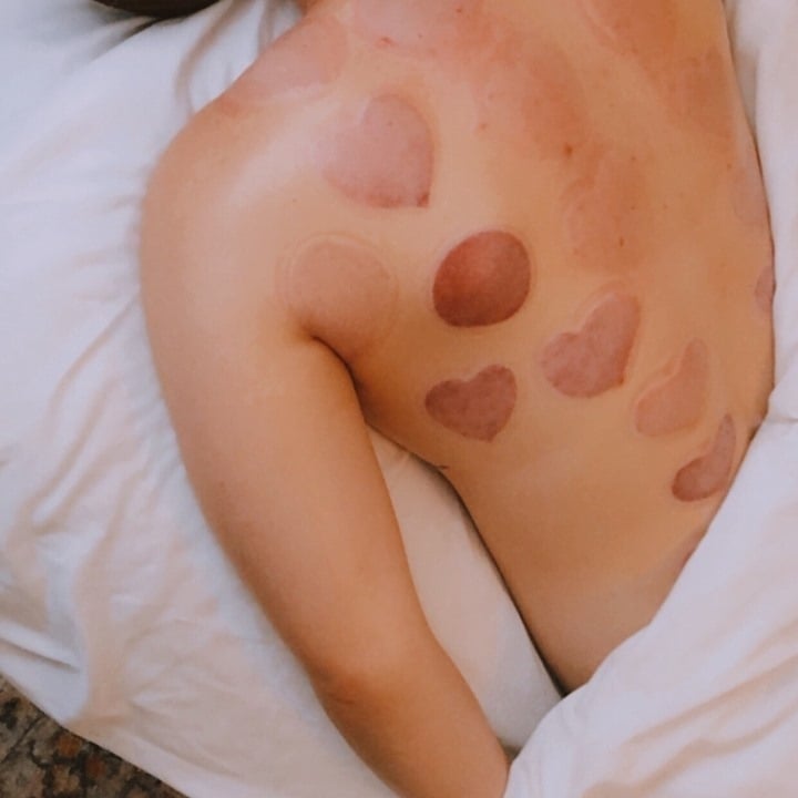Therapeutic cupping massage treatment in Spokane WA - ancient healing therapy for pain relief and muscle recovery